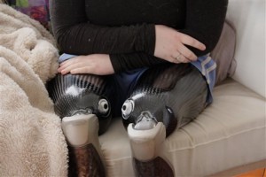 Clara Gardner, 24, shows her amputated legs at her Northampton apartment. Gardner, whose legs were crushed seven years ago, will undergo life-changing surgery in Australia. (Laura Newberry/The Republican via AP)